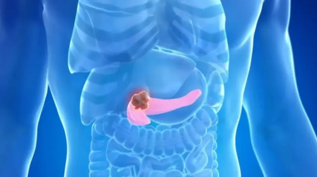 Investigadores identifican una de las claves de la agresividad del cáncer de páncreas